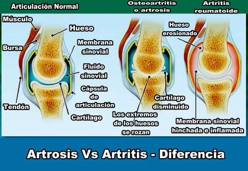Artrosis de rodilla remedios